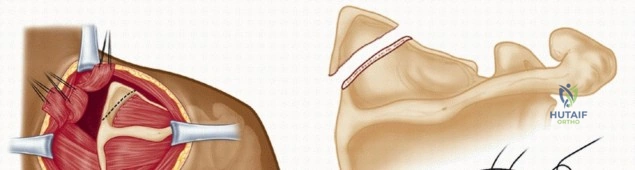 صورة طبية: متلازمة لوح الكتف الطقطقة الأسباب الأعراض والعلاج مع الأستاذ الدكتور محمد هطيف
