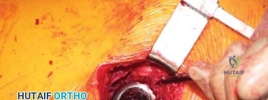 صورة طبية: استبدال مفصل الورك الكلي في العيادات الخارجية: دليل شامل من الأستاذ الدكتور محمد هطيف في صنعاء