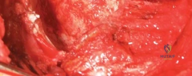 صورة توضيحية لـ مدخل هاردينج المعدل لجراحة الورك: دليل شامل لاستبدال مفصل الورك في صنعاء