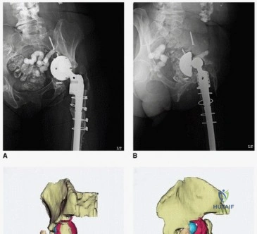 صورة توضيحية لـ الأجهزة ثلاثية الشفاه المخصصة: حل مبتكر لفقدان عظم الحوض الشديد واستعادة وظيفة مفصل الورك