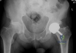 صورة توضيحية لـ استبدال سطح مفصل الورك: حلول متقدمة لآلام الورك المزمنة واستعادة النشاط في صنعاء