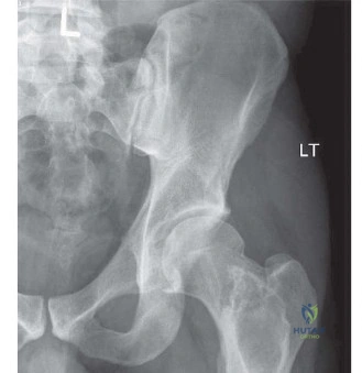 صورة رنين مغناطيسي T1-weighted تظهر تشوهات واسعة في إشارة نخاع العظم وآفات حالّة بؤرية في الحوض والجزء العلوي من الفخذين، تتوافق مع انتشار واسع لخلايا الورم النقوي المتعدد في نخاع العظم.