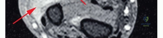 صورة توضيحية لأشعة سينية تظهر ورمًا عظميًا يتطلب بترًا