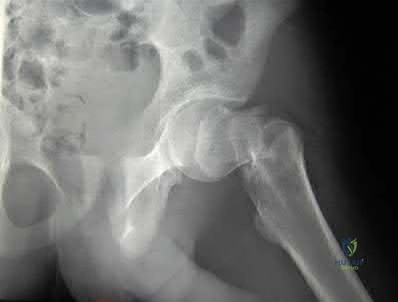صورة طبية: دليل شامل لكسور وإصابات الجهاز الحركي: رعاية متقدمة في صنعاء مع الأستاذ الدكتور محمد هطيف