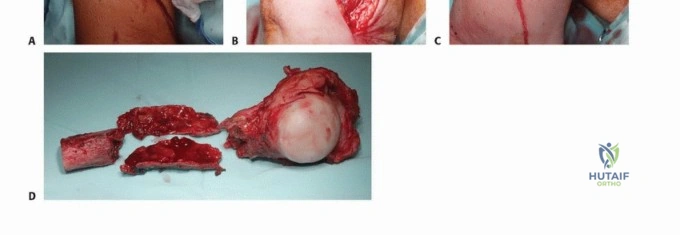 صورة طبية: جراحة نقائل عظم العضد: دليل شامل لاستعادة الوظيفة وتخفيف الألم في اليمن مع الأستاذ الدكتور محمد هطيف