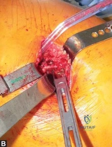 صورة طبية: استبدال مفصل الورك الكلي في العيادات الخارجية: دليل شامل من الأستاذ الدكتور محمد هطيف في صنعاء