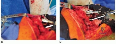 صورة طبية: مراجعة مفصل الورك بالإسمنت داخل الإسمنت: حلول متقدمة لعمليات استبدال الورك المعقدة مع الأستاذ الدكتور محمد هطيف
