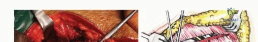صورة طبية: جراحة أورام العجز: الحفاظ على وظائف الأمعاء والمثانة مع الأستاذ الدكتور محمد هطيف في صنعاء