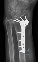 صورة طبية: دليل الأستاذ الدكتور محمد هطيف الشامل لأمراض وإصابات اليد والمعصم في صنعاء