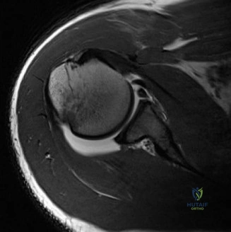 توضيح طبي: الكتف المتجمد يظهر تضيّق كبسولة المفصل