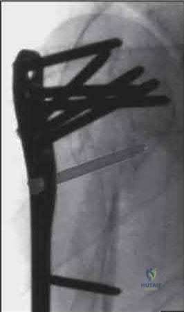 صورة طبية: دليل شامل لكسور وإصابات الجهاز الحركي: رعاية متقدمة في صنعاء مع الأستاذ الدكتور محمد هطيف
