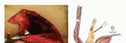 صور الأشعة قبل الجراحة للحالة الأولى