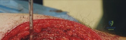 صورة طبية: النهج الخلفي لمفصل الورك: دليل شامل لاستعادة الحركة في صنعاء مع الأستاذ الدكتور محمد هطيف