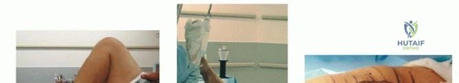 صورة توضيحية لـ جراحة استبدال مفصل الركبة الكلي بالأسمنت: حل دائم لتخفيف الألم واستعادة الحركة مع الأستاذ الدكتور محمد هطيف في صنعاء