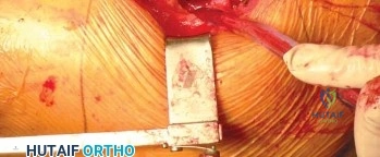 صورة طبية: استبدال مفصل الورك الكلي في العيادات الخارجية: دليل شامل من الأستاذ الدكتور محمد هطيف في صنعاء