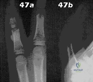 صورة طبية: دليلك الشامل لأمراض وإصابات العظام والمفاصل في اليمن: خبرة الأستاذ الدكتور محمد هطيف في صنعاء
