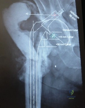 صورة توضيحية لـ تخطيط جراحة استبدال مفصل الورك المراجع المعقدة: دليلك الشامل لاستعادة الحركة مع الأستاذ الدكتور محمد هطيف