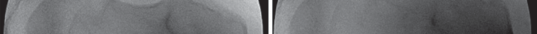 FRCS EMQs: Shoulder and elbow