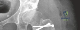Illustration of repair of the labrum - Dr. Mohammed Hutaif