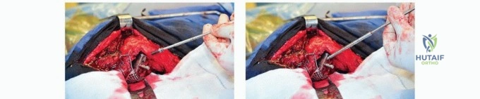 صورة طبية: مراجعة مفصل الورك بالإسمنت داخل الإسمنت: حلول متقدمة لعمليات استبدال الورك المعقدة مع الأستاذ الدكتور محمد هطيف