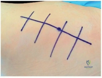 صورة توضيحية لـ استبدال مفصل الورك بالنهج الجانبي المباشر: دليلك الشامل لاستعادة الحركة والدقة