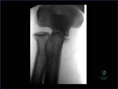 صورة طبية: دليل شامل لكسور وإصابات الجهاز الحركي: رعاية متقدمة في صنعاء مع الأستاذ الدكتور محمد هطيف