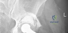 Illustration of porous tantalum cups - Dr. Mohammed Hutaif