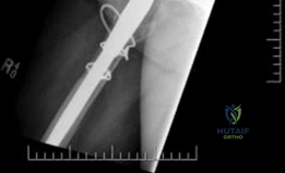 Illustration of acetabular bone loss - Dr. Mohammed Hutaif