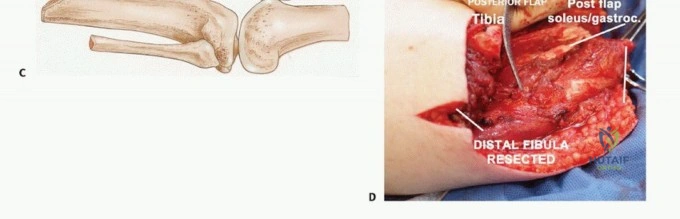 صورة توضيحية لـ بتر الساق تحت الركبة: دليل شامل للتعافي الأمثل واستعادة الوظيفة مع الأستاذ الدكتور محمد هطيف