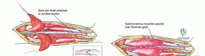صورة طبية: استئصال ورم العضلة النعلية: دليل شامل لحماية عضلة الساق والتعافي الكامل في صنعاء مع الأستاذ الدكتور محمد هطيف