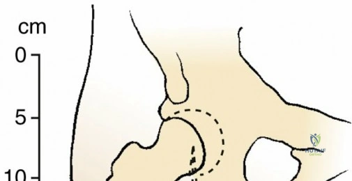 رسم تخطيطي تشريحي لأذرع عزم عضلات المقربة القصيرة والطويلة والكبيرة