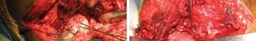 صورة طبية: استبدال مفصل الورك الكلي لالتهاب المفاصل الروماتويدي اليفعي: استعادة الحركة والأمل مع الأستاذ الدكتور محمد هطيف في صنعاء