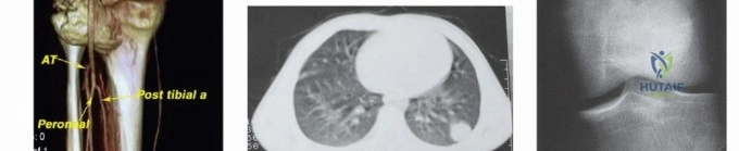 صورة توضيحية لـ أورام العظام والأنسجة الرخوة: دليلك الشامل للفهم والعلاج مع الأستاذ الدكتور محمد هطيف