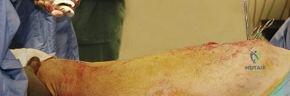 صورة طبية: النهج الخلفي لمفصل الورك: دليل شامل لاستعادة الحركة في صنعاء مع الأستاذ الدكتور محمد هطيف