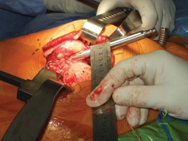 صورة طبية: استبدال مفصل الورك الكلي الناجح في خلل التنسج النمائي للورك: دليل شامل من الأستاذ الدكتور محمد هطيف