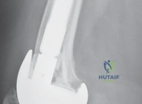 صورة طبية: إتقان موازنة الفجوة في مراجعة استبدال مفصل الركبة: تجنب الأخطاء الشائعة واستعادة الحركة مع الأستاذ الدكتور محمد هطيف