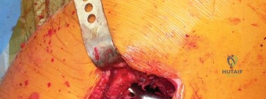 صورة طبية: استبدال مفصل الورك الكلي في العيادات الخارجية: دليل شامل من الأستاذ الدكتور محمد هطيف في صنعاء