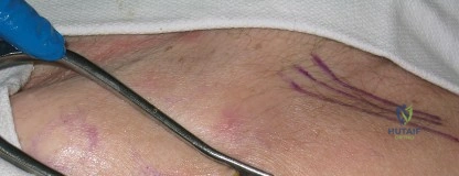 صورة طبية: استبدال مفصل الورك بالحد الأدنى من التدخل الجراحي: تقنيات متقدمة، فوائد وتحديات