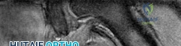 صورة توضيحية لـ جراحة تقليل رأس الفخذ المحافظة: استعادة وظيفة الورك لشباب صنعاء مع الأستاذ الدكتور محمد هطيف