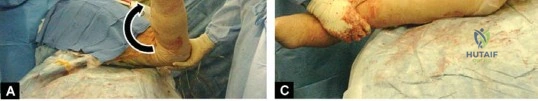 صورة طبية: إتقان توازن الأنسجة الرخوة لمفصل ورك صناعي مثالي: دليل شامل للمرضى مع الأستاذ الدكتور محمد هطيف