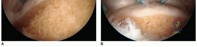 صورة توضيحية لـ تنظير مفصل الورك لعلاج آلام الورك الناتجة عن الأمراض غير الهيكلية: دليل شامل