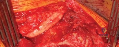 صورة توضيحية لـ مدخل هاردينج المعدل لجراحة الورك: دليل شامل لاستبدال مفصل الورك في صنعاء