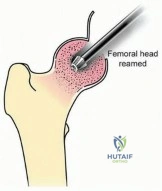 Illustration 9 for Head-Sparing for Osteonecrosis of the Femoral: Preserve Your Hip