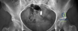 Illustration of surgical hip dislocation - Dr. Mohammed Hutaif