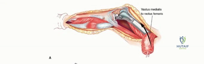 صورة طبية: النقائل العظمية الفخذية: دليل شامل للعلاج واستعادة الوظيفة مع الأستاذ الدكتور محمد هطيف في صنعاء