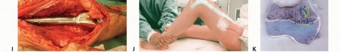 صورة طبية: الأطراف الصناعية القابلة للتمدد للأطفال: دليل شامل للمرضى حول الوقاية من العدوى والعلاج في صنعاء مع الأستاذ الدكتور محمد هطيف