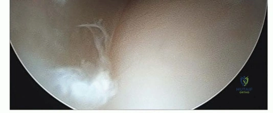 فحص سريري دقيق لمفصل الورك بواسطة الأستاذ الدكتور محمد هطيف