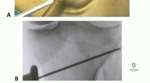 صورة طبية: قطع عظم الظنبوب العالي: إعادة محاذاة الركبة لتخفيف دائم لآلامها مع الأستاذ الدكتور محمد هطيف