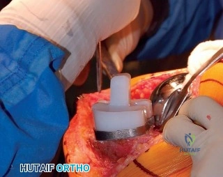 صورة طبية: إتقان موازنة الفجوة في مراجعة استبدال مفصل الركبة: تجنب الأخطاء الشائعة واستعادة الحركة مع الأستاذ الدكتور محمد هطيف