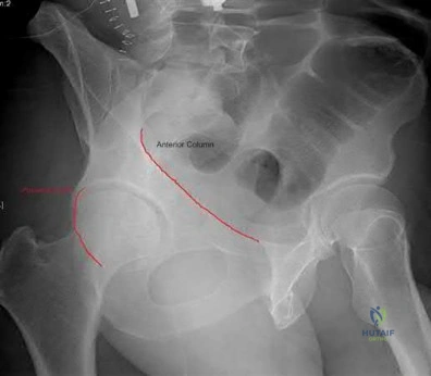 صورة طبية: دليل شامل لكسور وإصابات الجهاز الحركي: رعاية متقدمة في صنعاء مع الأستاذ الدكتور محمد هطيف